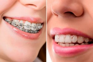 ortodoncia-invisible-invisaling_orthosteticsdental-clinic
